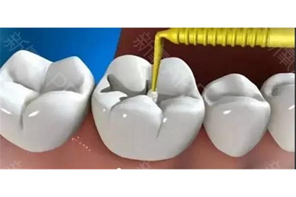 光固化樹脂補牙材料可以使用多久