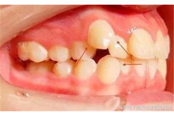 拔牙后補牙需要多久,補牙需要多久?