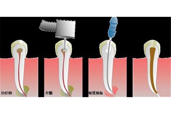 根管補牙需要多長時間?一個根管治療一顆牙有幾個根管?