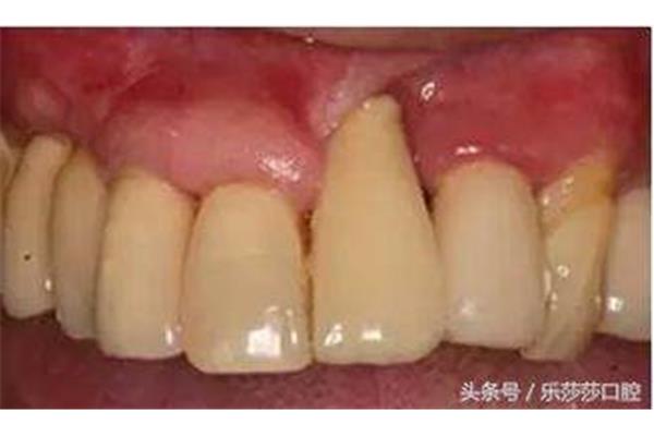 牙齒脫落后多久會出現牙齦萎縮,中度牙齦萎縮牙齒可以用多久?