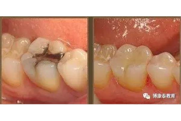 一顆牙可以補多久?如果牙齒爛了,疼得厲害嗎?