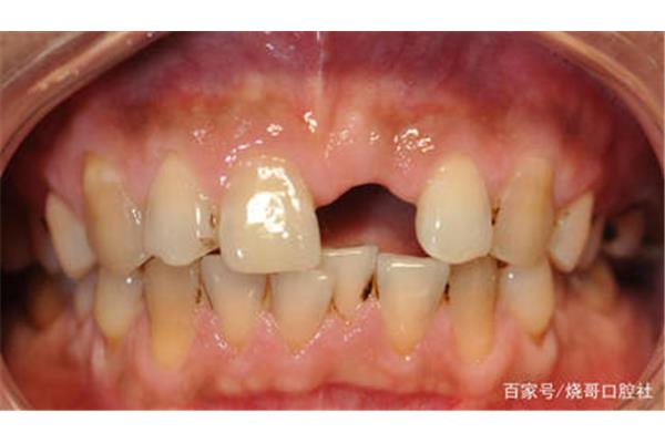 牙齒需要多久才能恢復正常,根管治療后牙齒需要多久才能恢復正常?