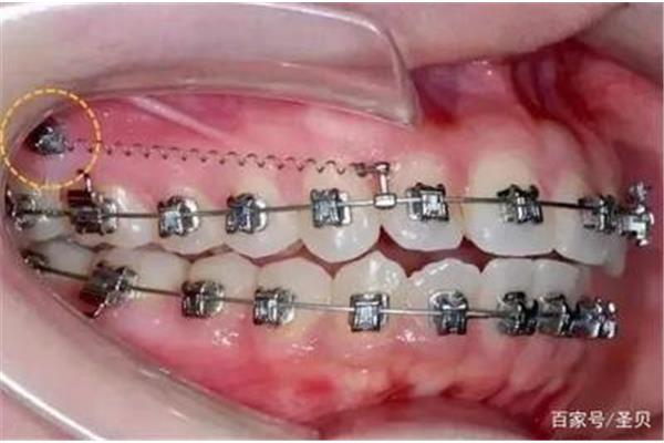 骨釘后多久可以正常進食,4個支抗釘后牙齒能恢復多少?