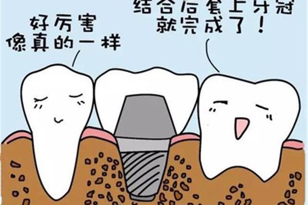 種植牙會很痛嗎,需要多長時間?分享種植牙后的護理要點