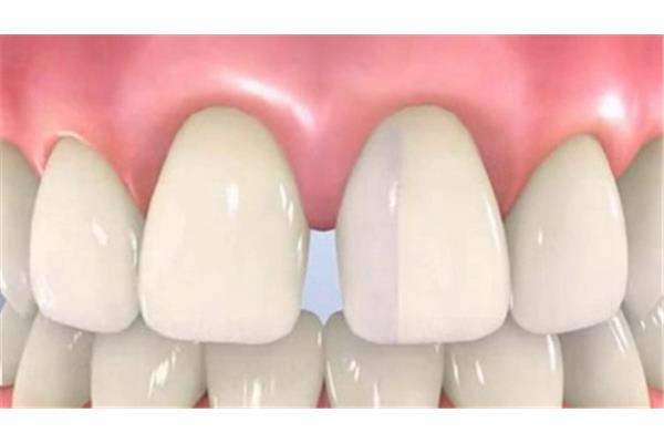 補牙的美學樹脂可以用多久,用樹脂填的牙可以用多久?
