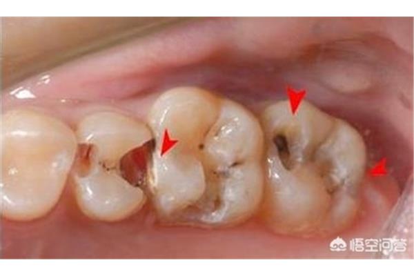甲硝唑銼治牙痛多久見效甲硝唑治牙痛多久見效?