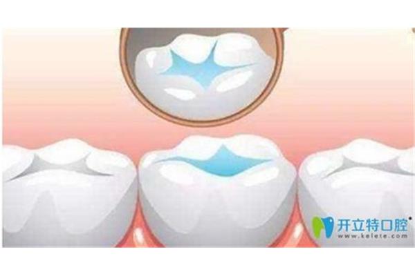 補一顆蛀牙需要多長時間?蛀牙牙根疼怎么辦?