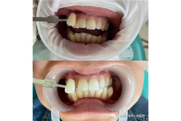 矯正牙齒戴牙套需要多長時間,牙齒戴牙套一般需要多長時間變整齊