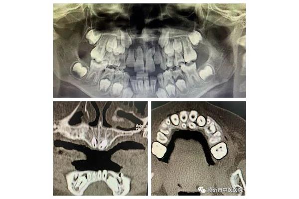 牙CT片可以用多久