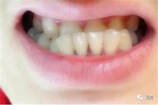 30多歲矯正牙齒,矯正牙齒可以做到幾歲?