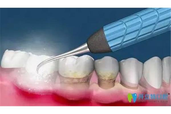 慢性牙周炎怎么治療?牙齦發炎多久好?