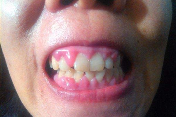 牙齦囊腫手術多久消腫