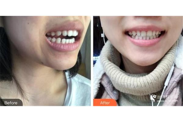 牙齒矯正的流程,做牙齒矯正需要多長時間?