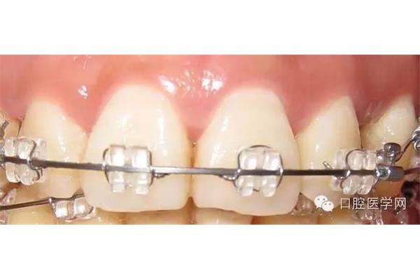 推牙彈簧可以用多久矯正牙齒?推簧校正器將齒隙推開