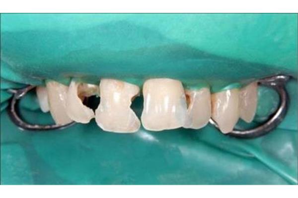 殘根需要多長時間拔掉,蛀牙拔掉后牙齒可以固定多久?