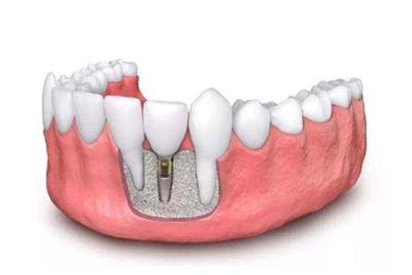 拔牙種植牙后多久能止疼,種植牙最快多久能恢復?