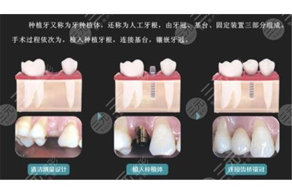 種植牙可以用幾年?現在種植牙能管多久?