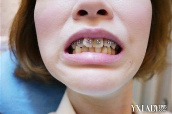牙套多久會消失,牙套多久會痊愈?