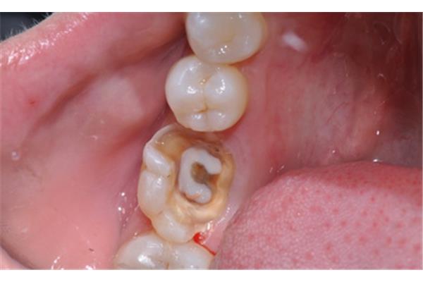化學性根尖周炎怎么治療,牙髓炎怎么治療?
