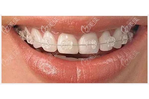 牙齒需要多久才能擺動牢固,牙套矯正牙齒需要多久?