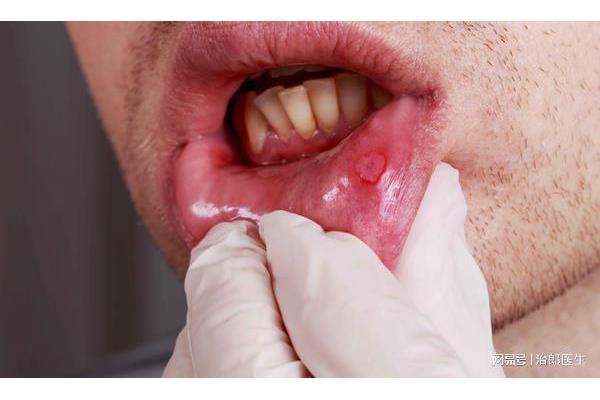 口腔黏膜科在哪家醫院最好,灼口綜合征一輩子都不會好?
