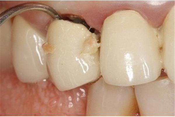 烤瓷牙做完后牙齦萎縮怎么辦?普通烤瓷牙能用多久?