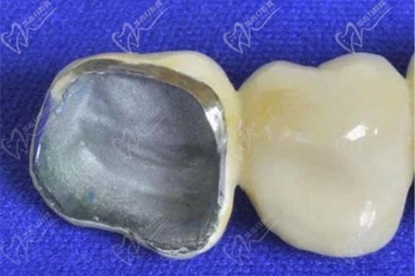 全瓷牙多久消腫,全瓷牙拔掉后牙齦多久能恢復?