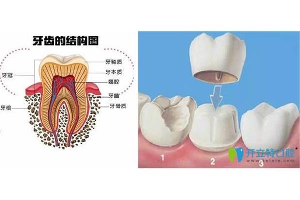 缺牙臨時牙套可以戴多久,根管治療后臨時牙套可以用多久?