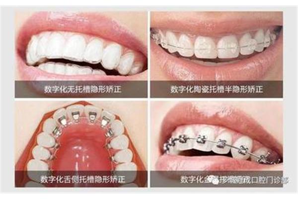 <a href=https://www.nkjjw.org/jiaozhengyachi target=_blank class=infotextkey>矯正牙齒</a>多久后洗牙
