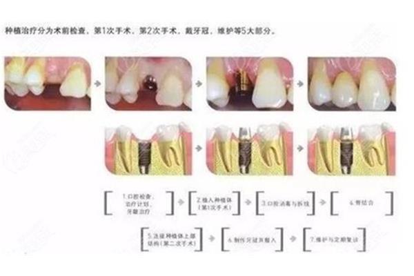 我聽說有一種立即種植的技術拔牙后多長時間種牙最好?