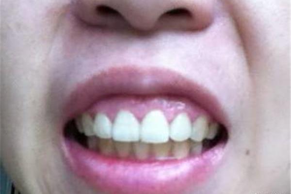 矯正牙齒前突需要多少錢?牙齒前突怎么矯正?