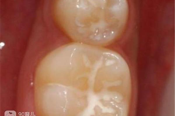 給孩子牙齒用保護膜有害嗎?獲取牙齒保護膜