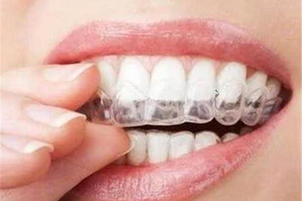 做一個牙齒固定器需要多長時間?做一個牙齒固位體一般需要多長時間?