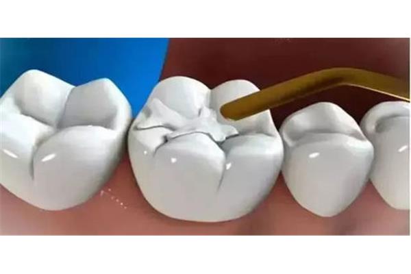 樹脂牙需要多久才能完全固化,牙齒樹脂需要多久才能發揮作用?