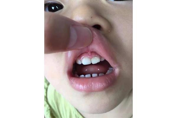 矯正牙齒需要多長時間?兒童正畸