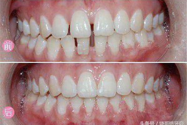 矯正門牙和收緊牙齒需要多長時間?
