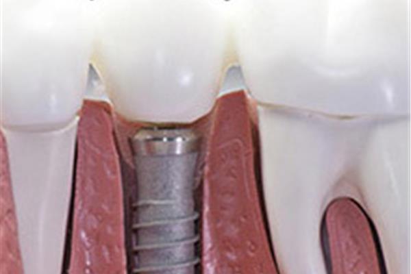 完成手術需要多長時間,種一顆牙需要多長時間?