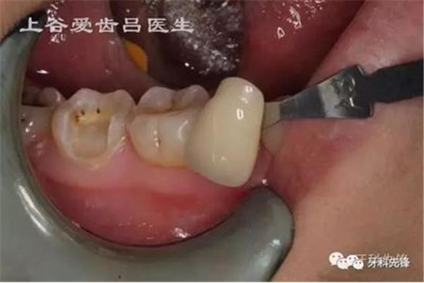 根管治療后不用牙套可以用多久?根管治療后沒做牙套