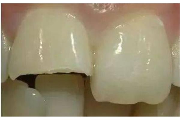 牙齒裝一個可以管多久時間