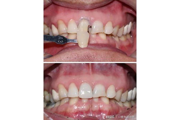 門牙缺損貼面能用多久