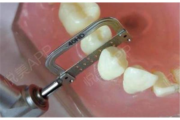 牙齒切片需要多久,牙齒完全恢復需要多久?