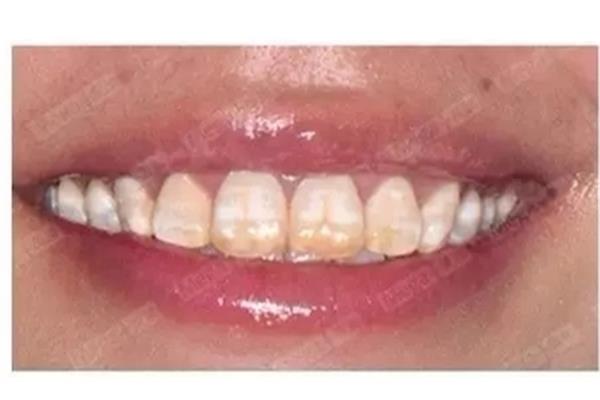 牙齒美白一次能美白多久,洗牙一次能洗牙多久?