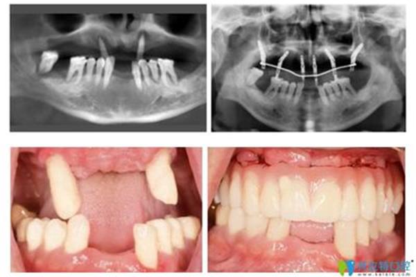 種植牙手術時間和種植牙手術后吸煙的后果
