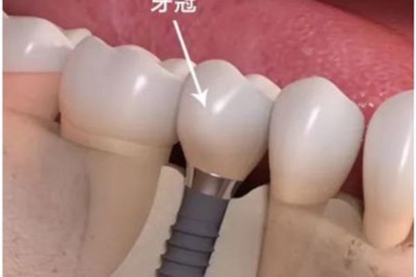 臨時牙最多能戴多久?臨時牙可以戴一年嗎?