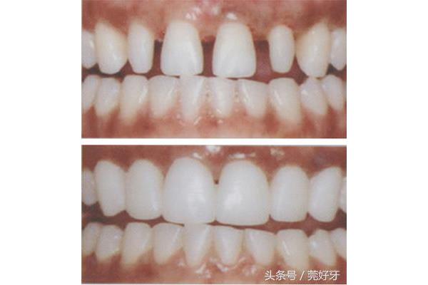 輕微齙牙需要多久矯正牙齒,40歲矯正齙牙需要多久?