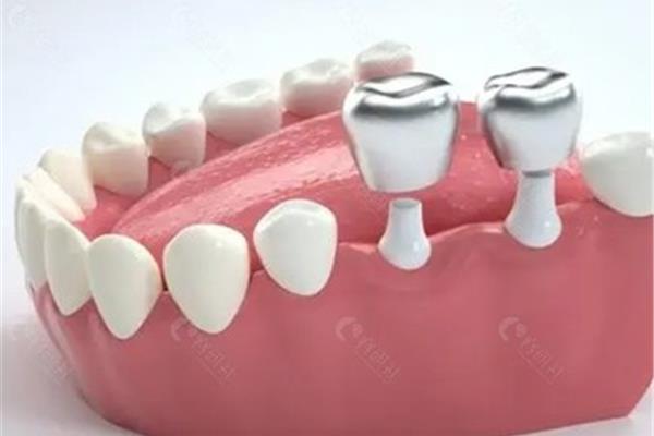 門牙植入后多久可以裝臨時牙?種植牙的臨時牙穩定嗎?