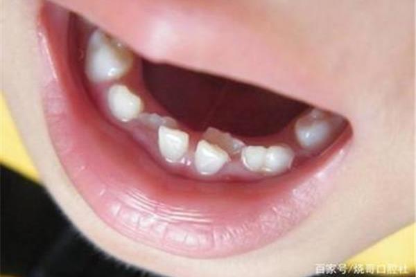 6歲孩子的多生牙一定要拔掉嗎?恒牙要多久才能完全長出來?