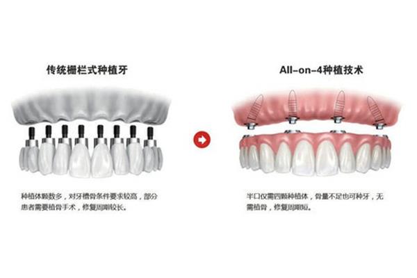 種牙后多久可以帶臨時牙,鄭州梅瑋口腔醫院總院