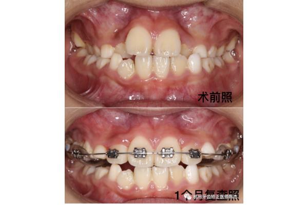 4 PCs 門牙地包天矯正要多久,有必要只矯正門牙嗎?