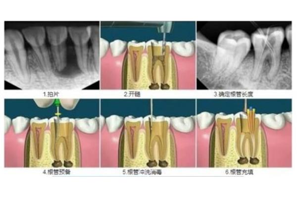 根管治療需要多長時間?補牙后帶牙套能堅持多久?